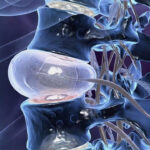 PLID এর জন্য কোন ডাক্তারের পরামর্শ নেওয়া উচিত