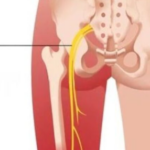 পা অবশ হওয়ার কারণ ও প্রতিকার